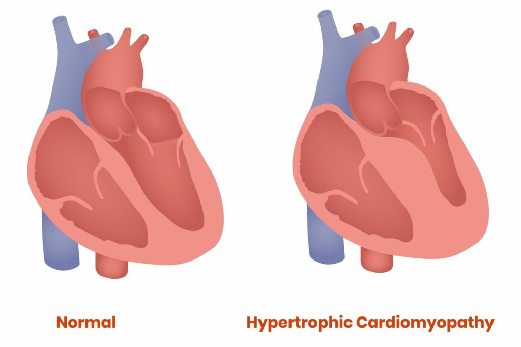 dessin d'un coeur sain et d'un coeur atteint de cardiomyopathie hypertrophique